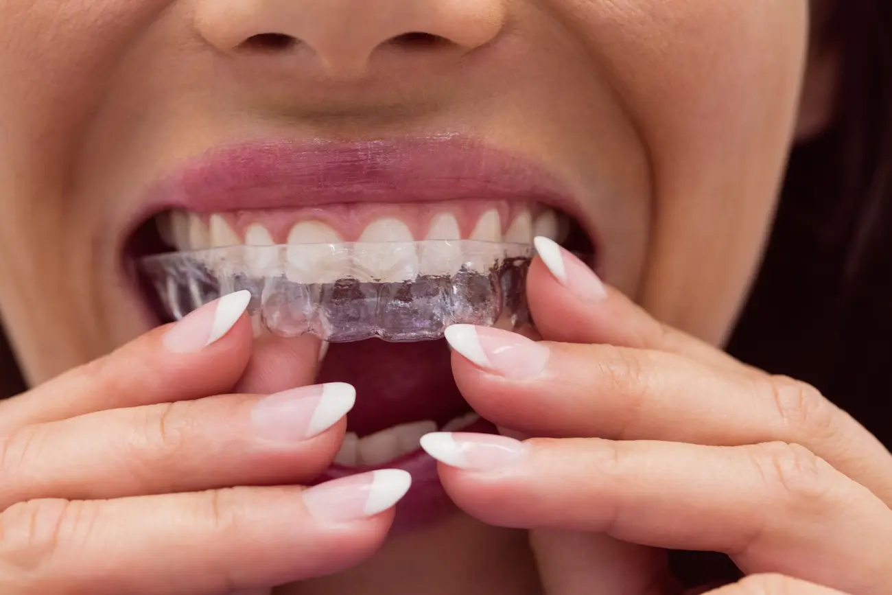 seffaf-plak-invisalign -nasil-calisir