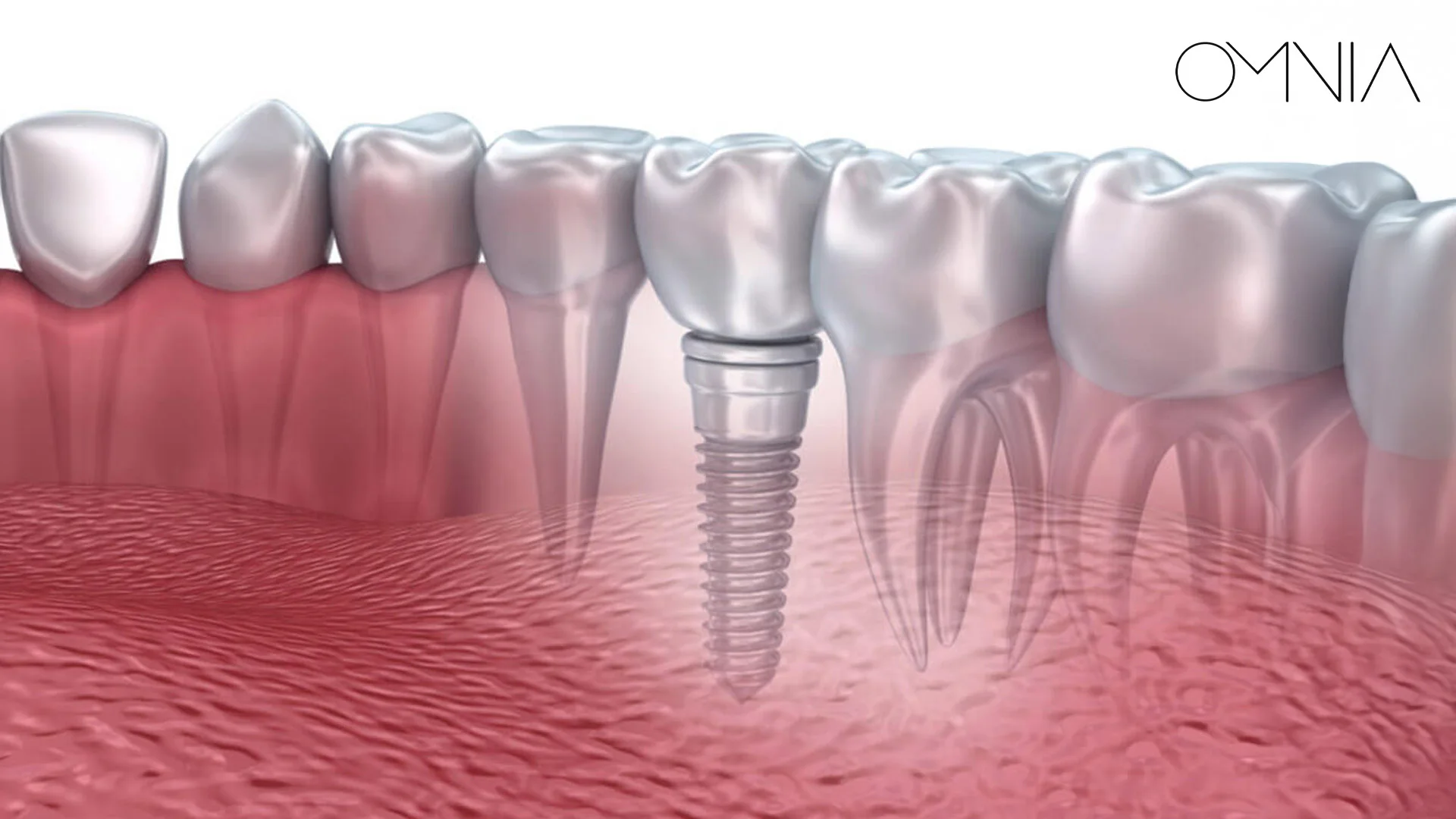 implant-tedavisi-fiyatları