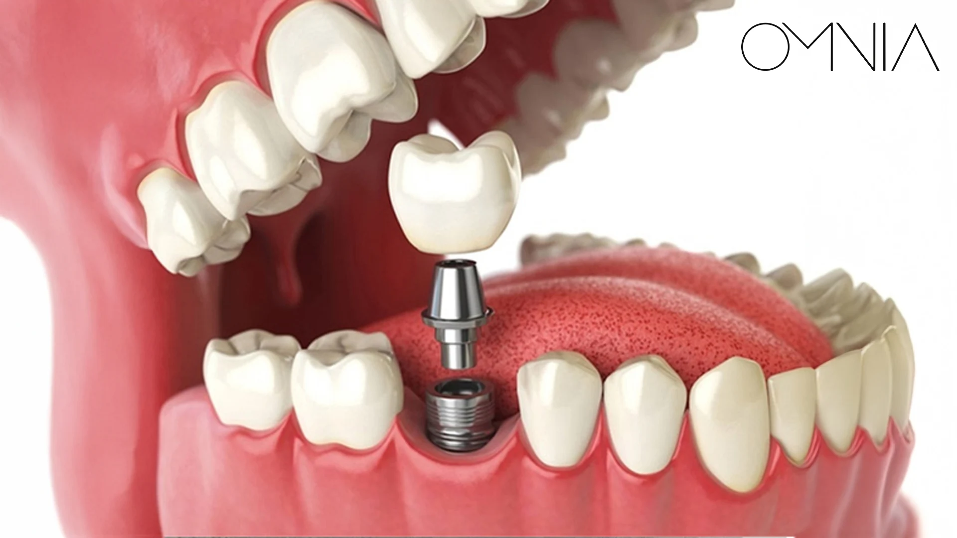 implant-diş-takıldıktan-sonra-dikkat-edilmesi-gerekenler