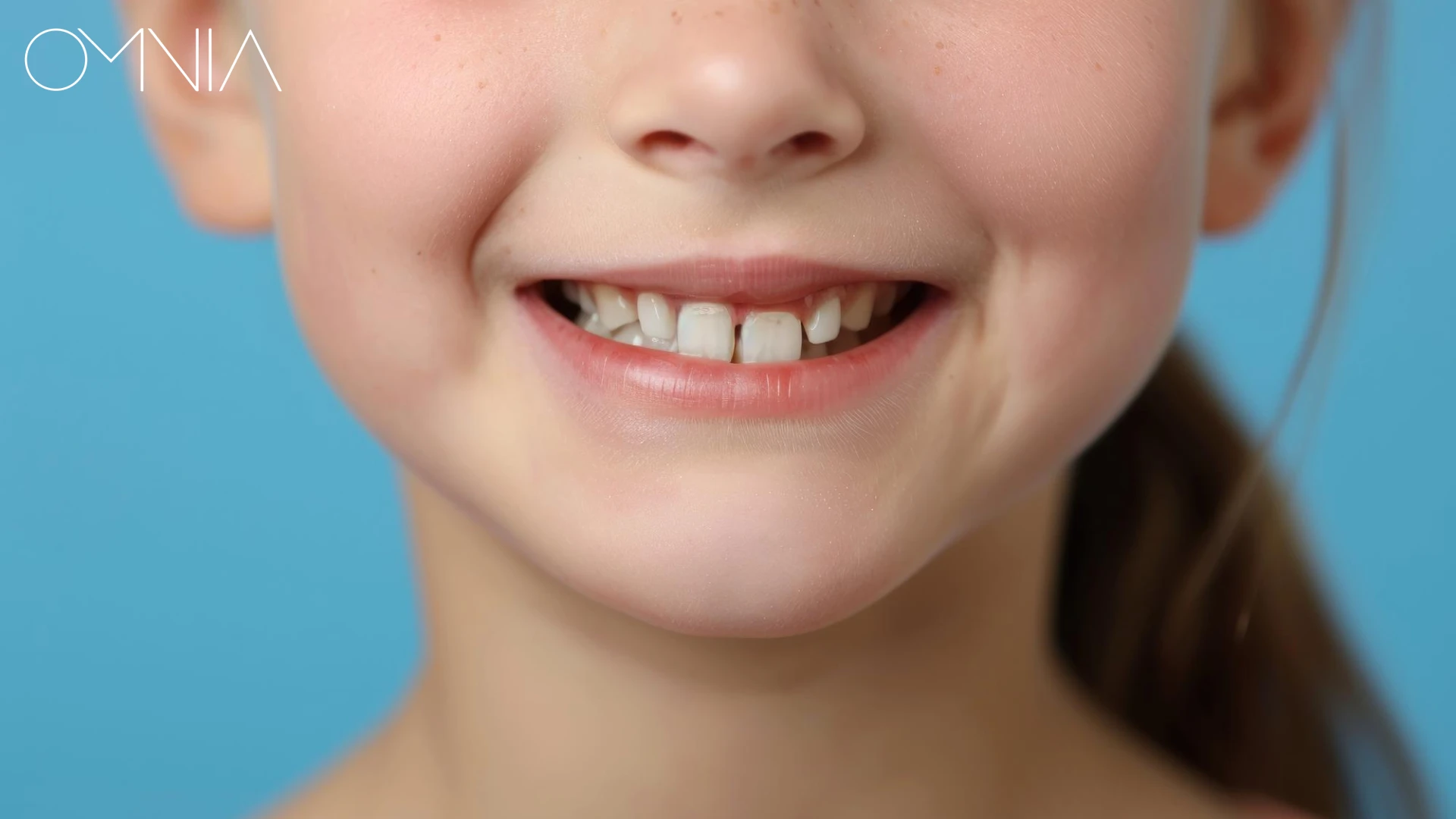 diastema_ayrik_dis_nedir_nasil_tedavi_edilir_banner